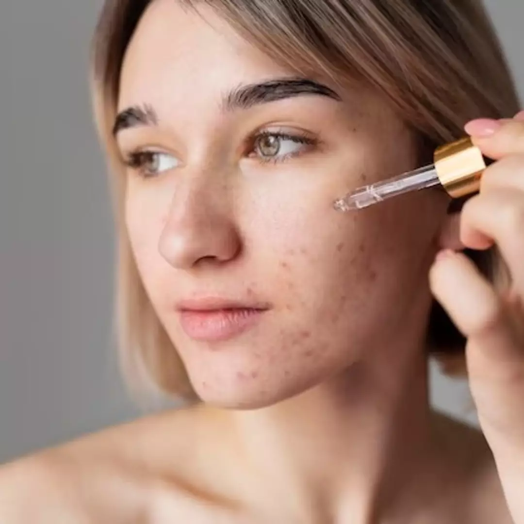 11 Rekomendasi skincare untuk menghilangkan bekas jerawat hitam di bawah Rp 200 ribu, wajah bebas noda