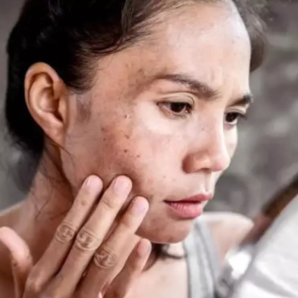 Glowing tanpa krim pemutih, ini trik bikin serum hempas flek hitam pakai 1 jenis bumbu dapur