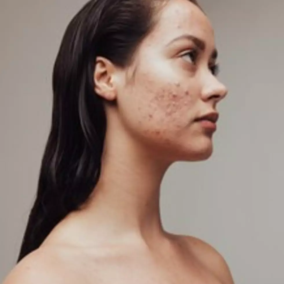 Bukan dioles kunyit, ini trik hilangkan jerawat dan bekas sampai ke akar pakai 1 jenis buah