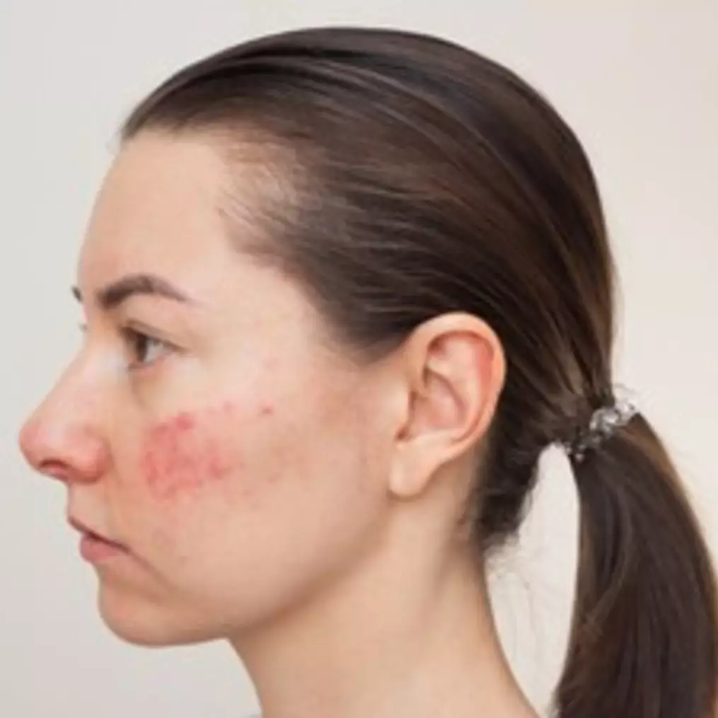 Tak perlu serum BHA, ini cara hilangkan jerawat sebelum meradang pakai 1 ekstrak daun herbal