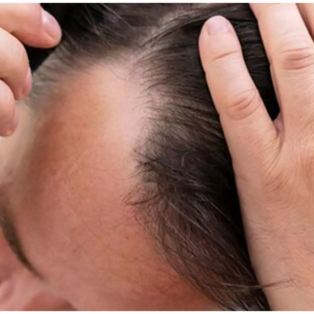 Tanpa gunakan minyak kemiri, ini cara menumbuhkan rambut botak pakai 1 ekstrak bunga