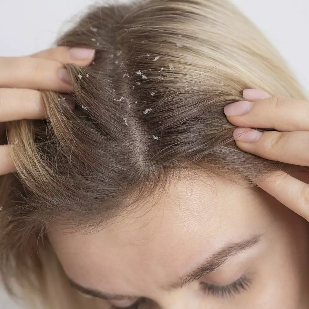 Kulit kepala antigatal, ini cara optimalkan sampo untuk menghilangkan ketombe membandel pakai 1 buah