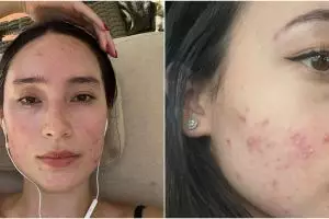 Potret 11 seleb tampil percaya diri unggah wajah berjerawat, Tatjana Saphira dipuji glowing