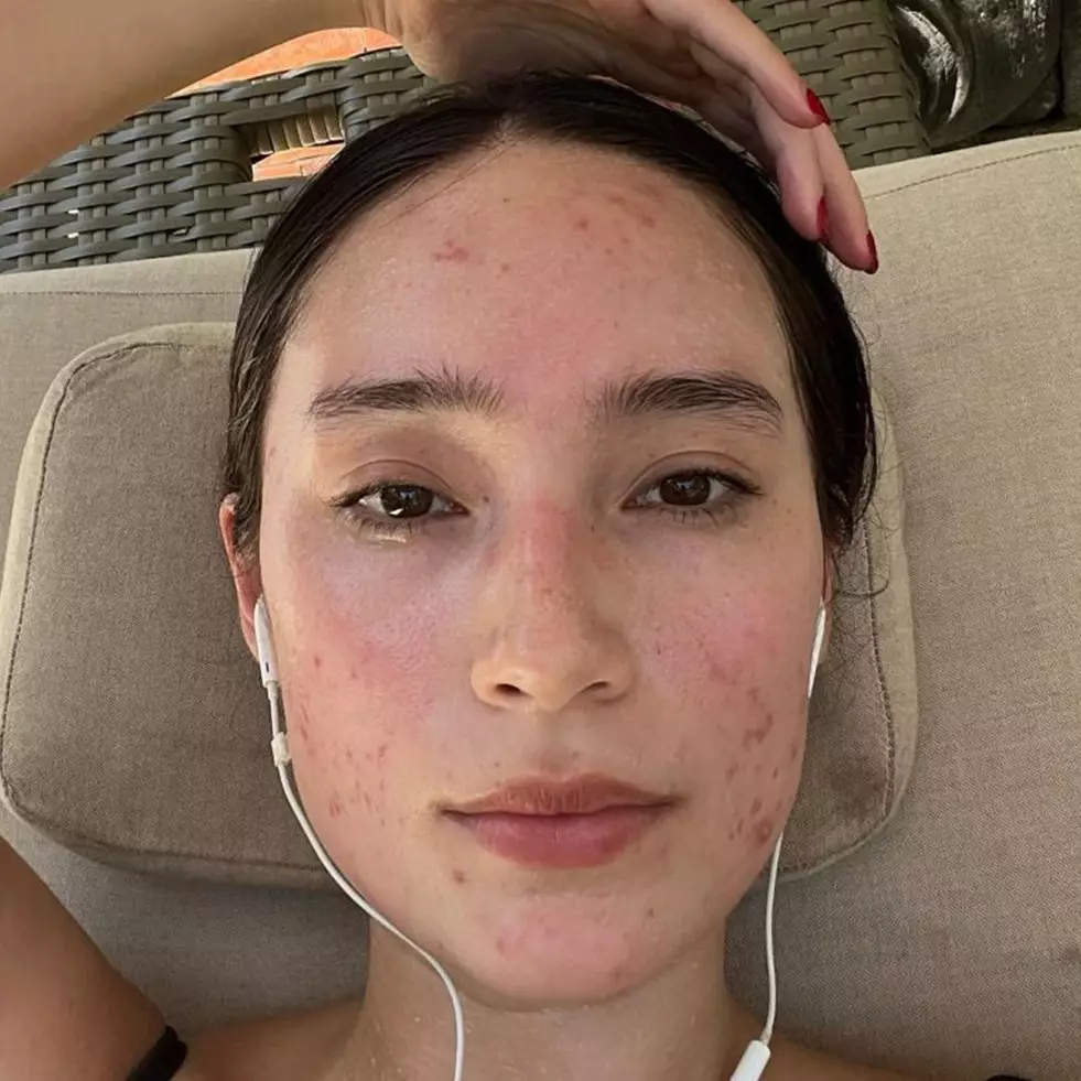 Potret 11 seleb tampil percaya diri unggah wajah berjerawat, Tatjana Saphira dipuji glowing