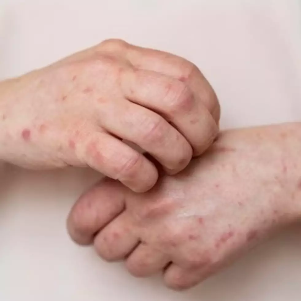 Tak perlu ke dokter kulit, ini cara atasi panu di tangan pakai 1 jenis bumbu dapur