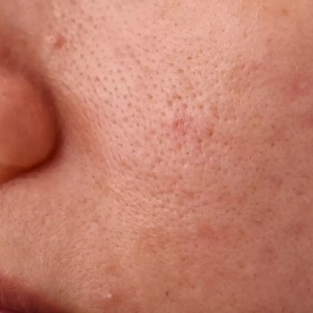 Halus tak perlu madu, ini trik atasi pori-pori besar di wajah kasar pakai 1 kulit buah