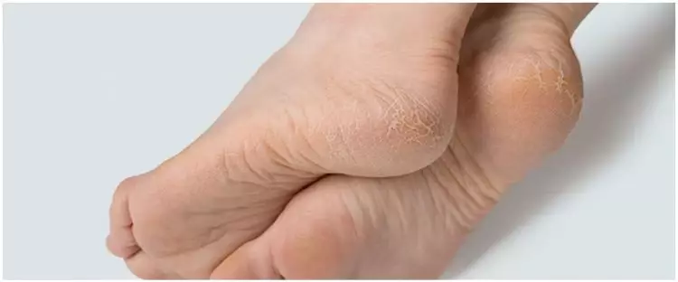 Tanpa direndam air garam, ini trik atasi tumit kaki pecah-pecah pakai 1 alat pembersih gigi