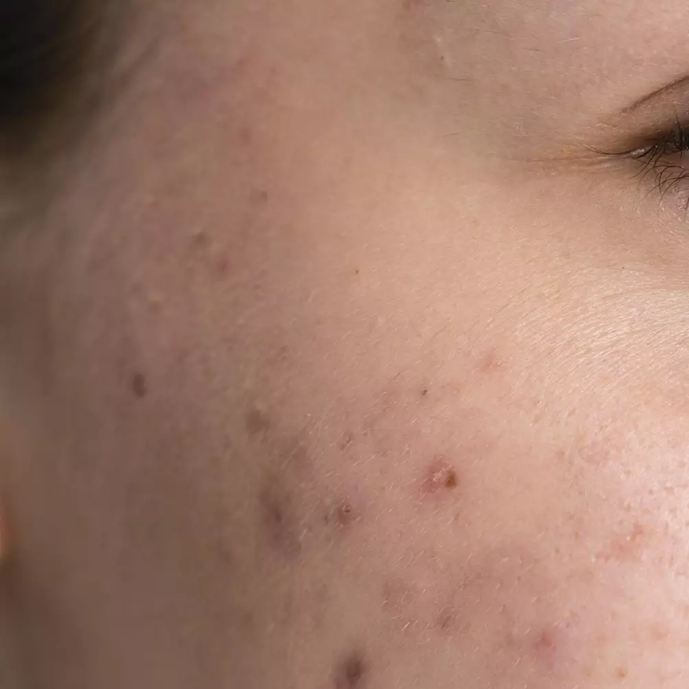 Tanpa krim pemutih, ini cara menghilangkan flek hitam di wajah pakai 1 bahan minuman