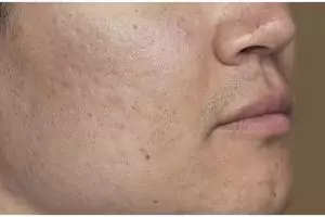 Bebas komedo tanpa scrub gula, ini trik bersihkan pori-pori wajah pakai face wash dari 3 jenis tepung