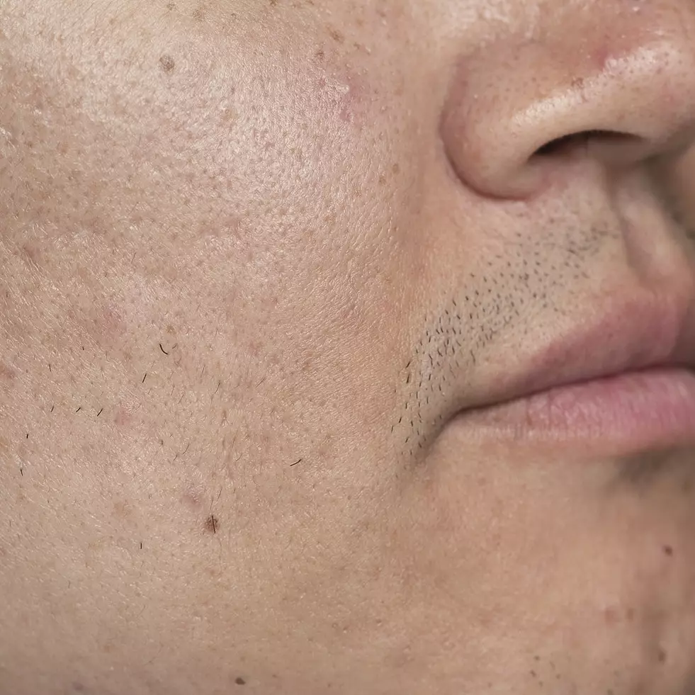 Bebas komedo tanpa scrub gula, ini trik bersihkan pori-pori wajah pakai face wash dari 3 jenis tepung