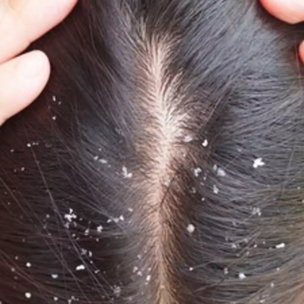 Cuma perlu 2 bahan dapur, trik hempas kerak ketombe di rambut ini bikin kepala auto bebas gatal