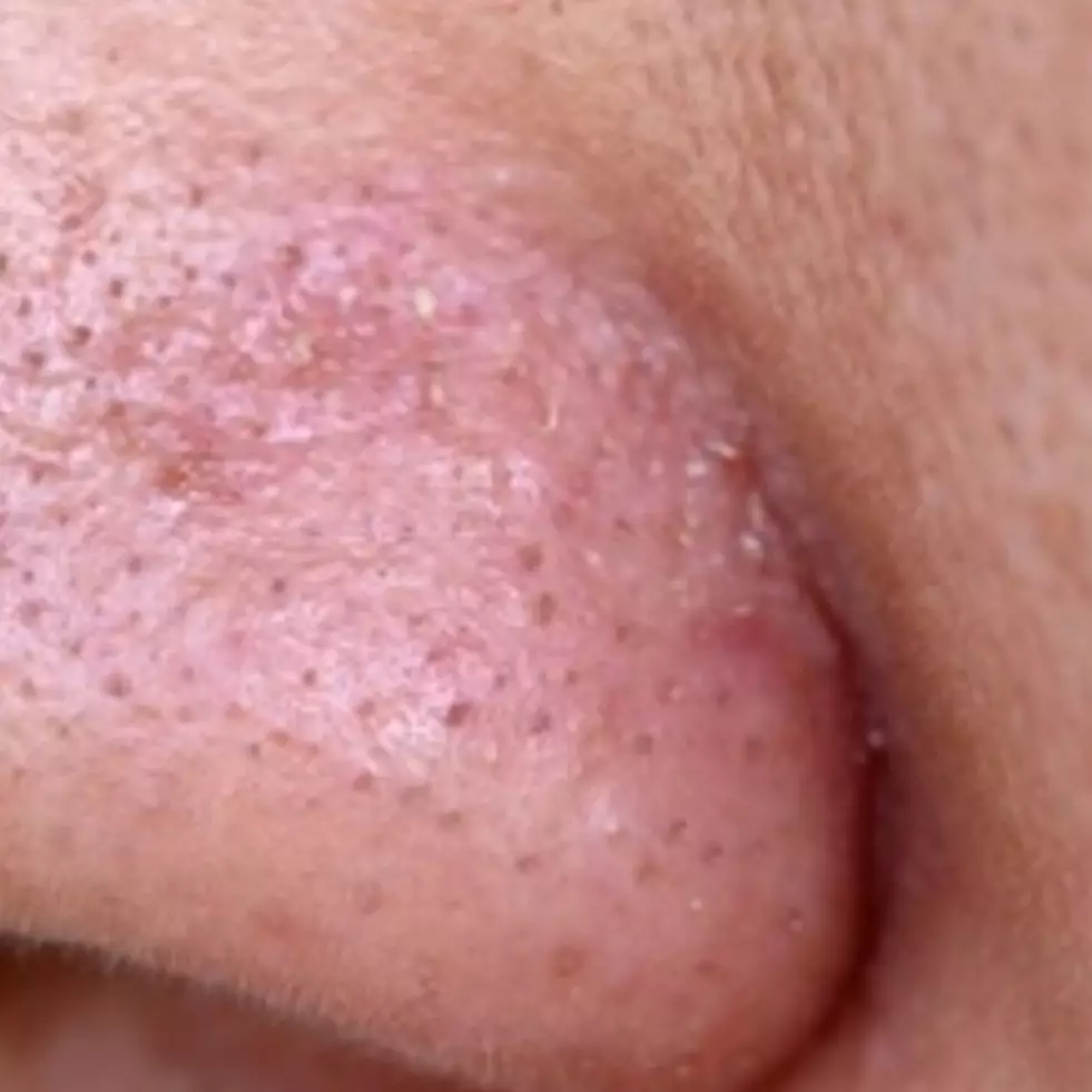 Tanpa mentimun, ini trik bikin wajah berpori-pori besar jadi bersih dan mulus pakai 2 makanan pokok