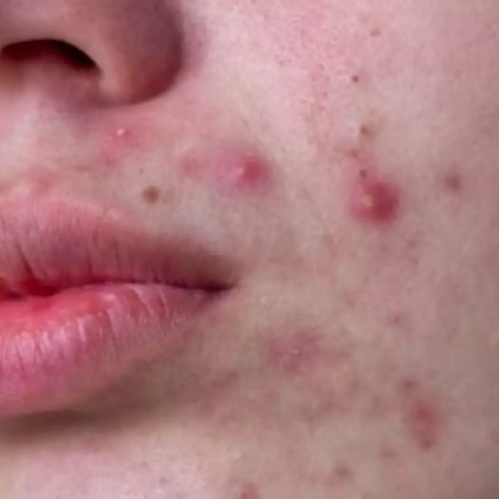 Bukan pakai teh hijau, ini trik atasi jerawat meradang pakai masker dari 1 jenis tanaman liar