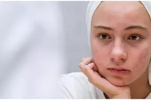 Tanpa toner eksfoliasi, ini cara hilangkan jerawat membandel di wajah pakai masker dari 1 jenis buah