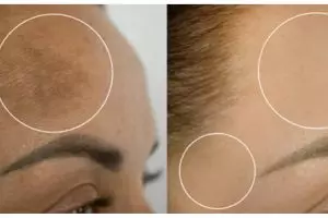 Tak hanya kunyit, ini cara hilangkan bekas pigmentasi kehitaman di wajah pakai 1 topping makanan