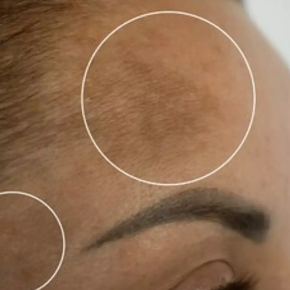 Tak hanya kunyit, ini cara hilangkan bekas pigmentasi kehitaman di wajah pakai 1 topping makanan