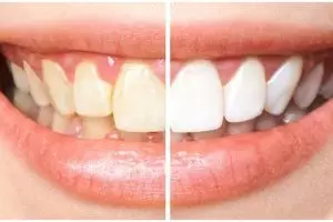 Tak pakai baking soda, ini trik rontokkan noda kuning pada gigi agar tampak cerah pakai 2 bahan alami