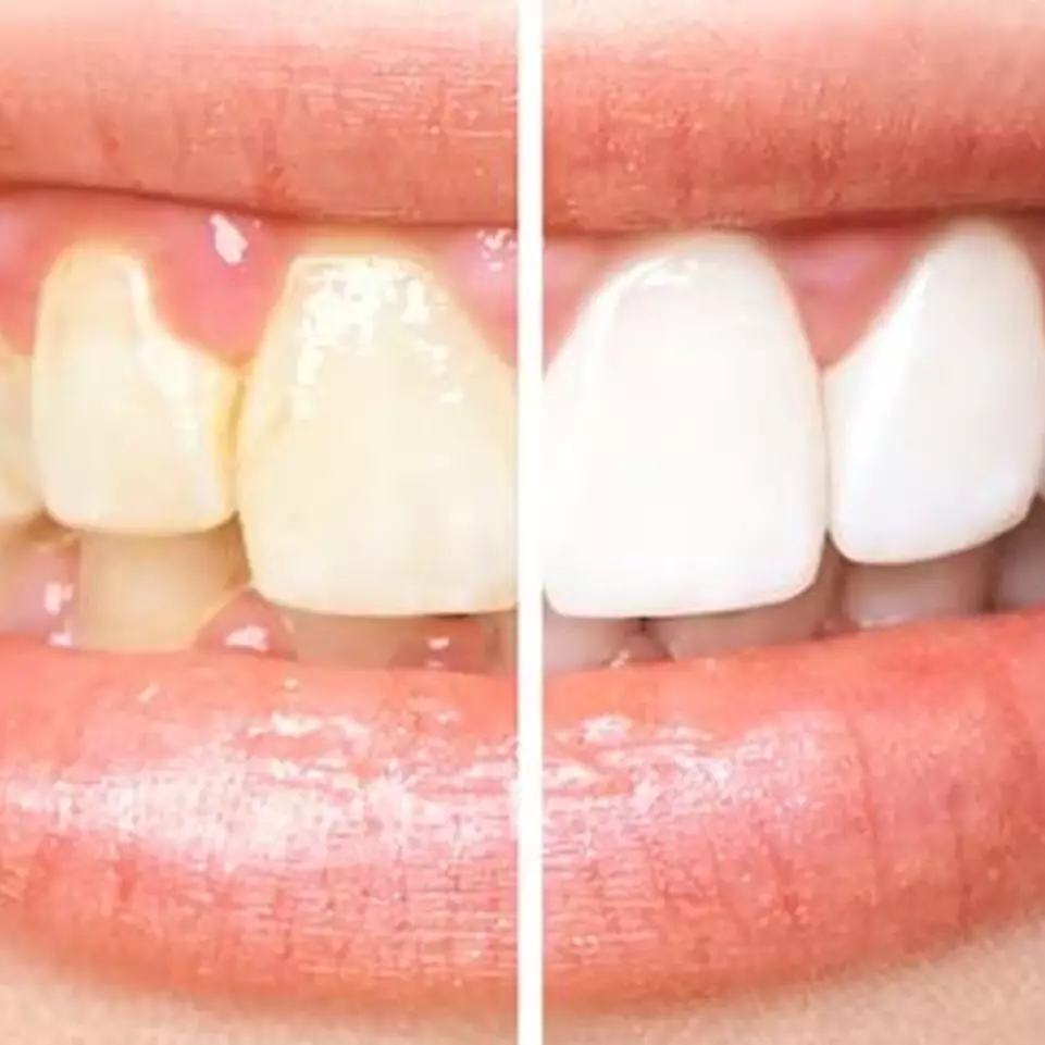 Tak pakai baking soda, ini trik rontokkan noda kuning pada gigi agar tampak cerah pakai 2 bahan alami