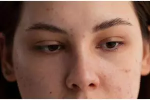 Tanpa krim pencerah, ini trik memutihkan flek hitam akibat jerawat pakai masker dari 1 jenis tepung