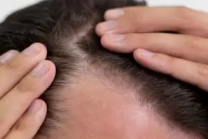 Tak perlu serum penumbuh, ini trik mengatasi rambut botak area dahi pakai 2 jenis minyak