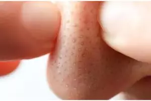 Tanpa gunakan pinset, ini cara optimalkan face wash untuk hilangkan komedo pakai 1 ekstrak bunga