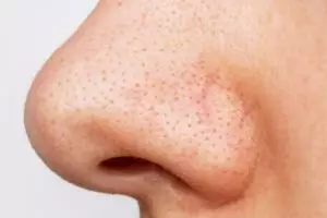 Wajah mulus tanpa facial, ini cara menghilangkan komedo hitam di area hidung pakai 1 jenis buah