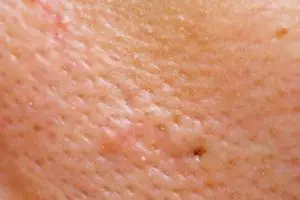 Antikomedo tanpa putih telur, ini trik bersihkan pori wajah tersumbat pakai 1 bahan makanan