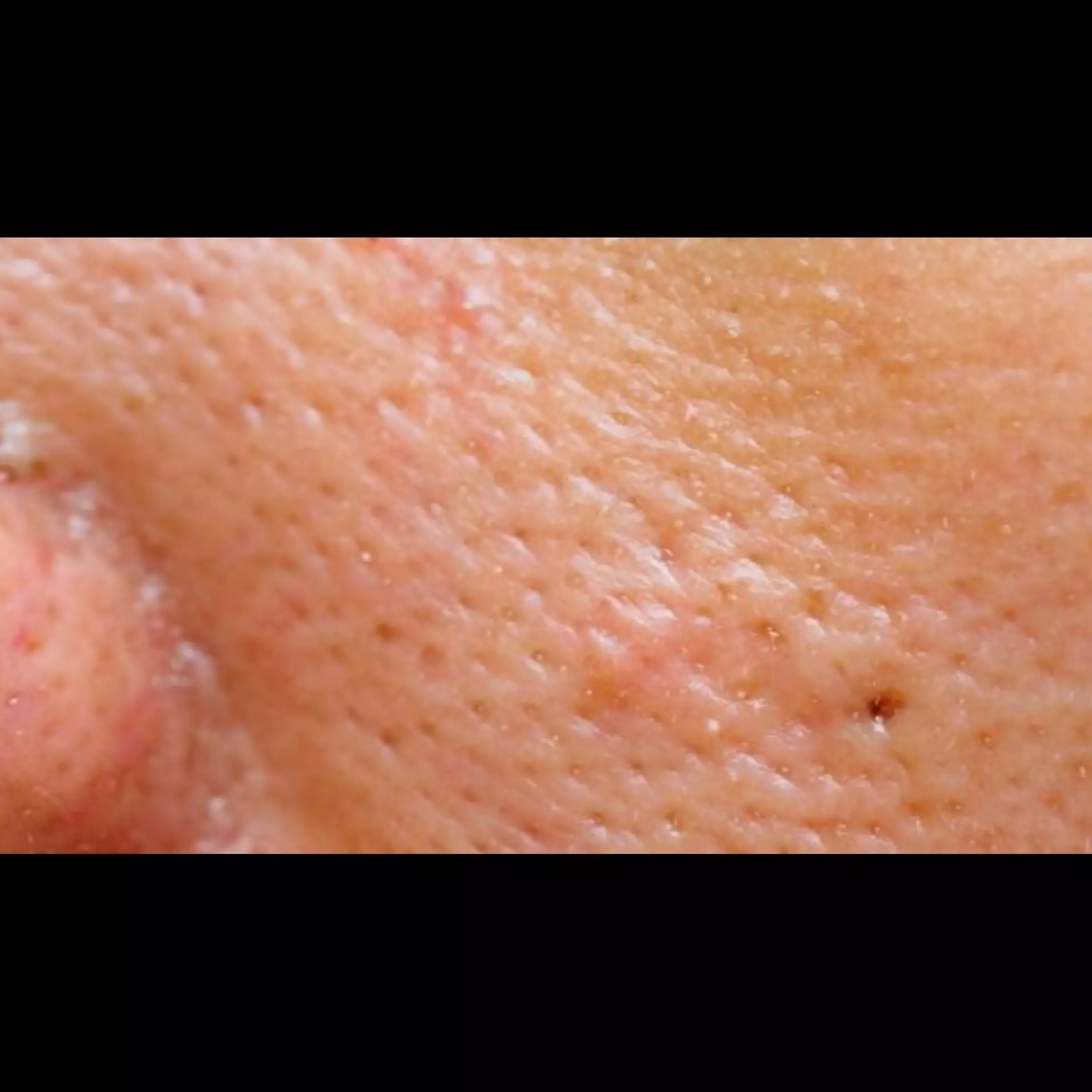 Antikomedo tanpa putih telur, ini trik bersihkan pori wajah tersumbat pakai 1 bahan makanan