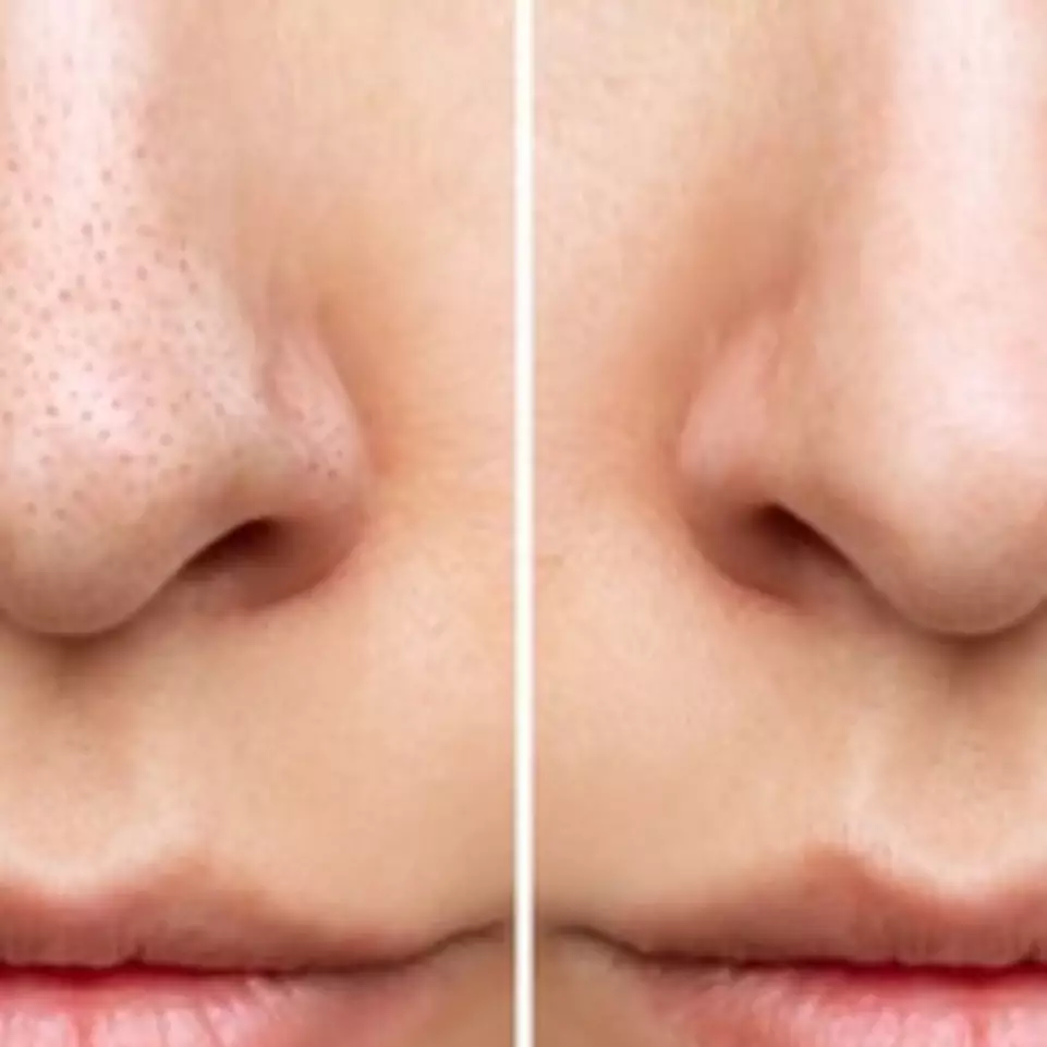 Tanpa madu atau teh hijau, ini trik bikin pori-pori rapat dan bersih dari komedo pakai 2 jenis buah