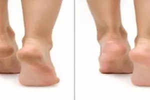 Mulus dalam 4 hari, ini cara atasi tumit kaki hitam penuh pecah-pecah pakai 1 jenis rempah dapur