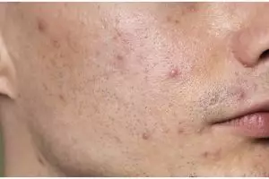 Tak gunakan mentimun, ini trik meredakan peradangan di wajah akibat jerawat pakai serum dari 1 buah