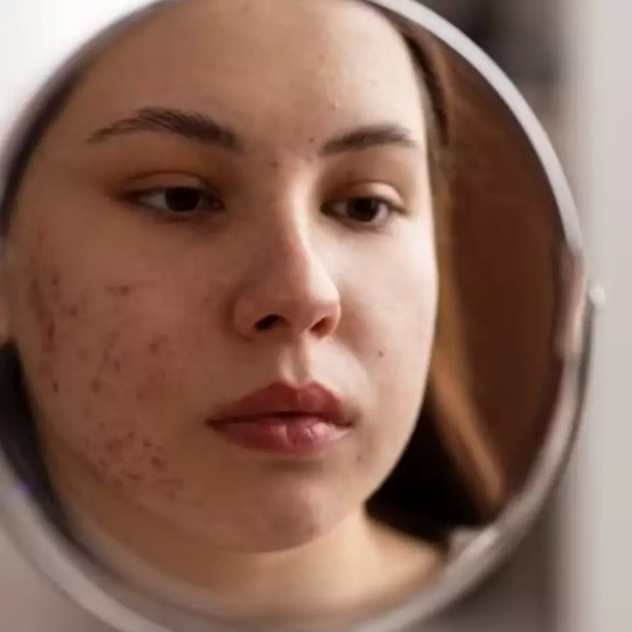 Tak perlu beli acne patch, ini trik atasi wajah penuh jerawat dan bekasnya pakai 1 bahan pemanis