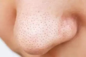 Wajah mulus tanpa pore pack, begini cara hempas komedo hitam di area hidung pakai 1 jenis protein