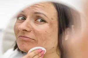 Tanpa perawatan laser, begini trik pudarkan flek hiperpigmentasi wajah cuma pakai 2 jenis buah