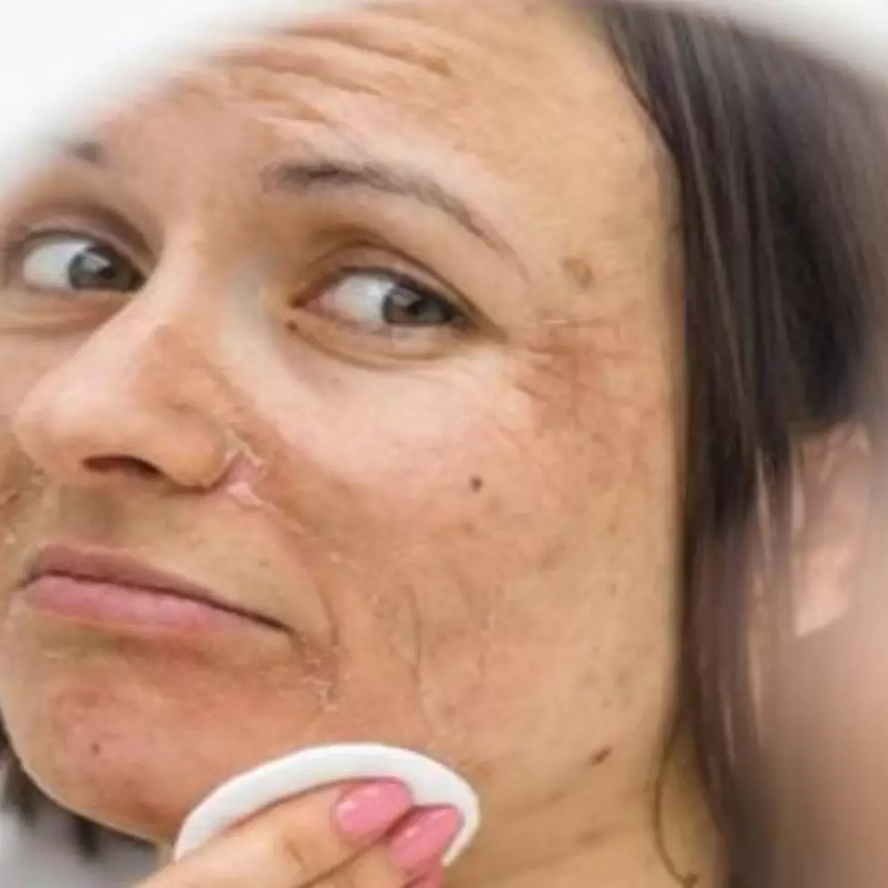 Tanpa perawatan laser, begini trik pudarkan flek hiperpigmentasi wajah cuma pakai 2 jenis buah