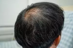 Tak perlu habbatussauda, ini trik atasi rambut rusak dan beruban pakai 1 makanan pokok