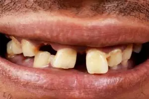 Tanpa baking soda dan lemon, ini cara simpel rontokkan noda kuning pada gigi cuma pakai 1 jenis daun