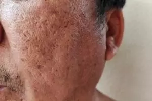 Bukan cuma kunyit, ini trik haluskan wajah kasar berpori-pori besar pakai 1 sumber protein