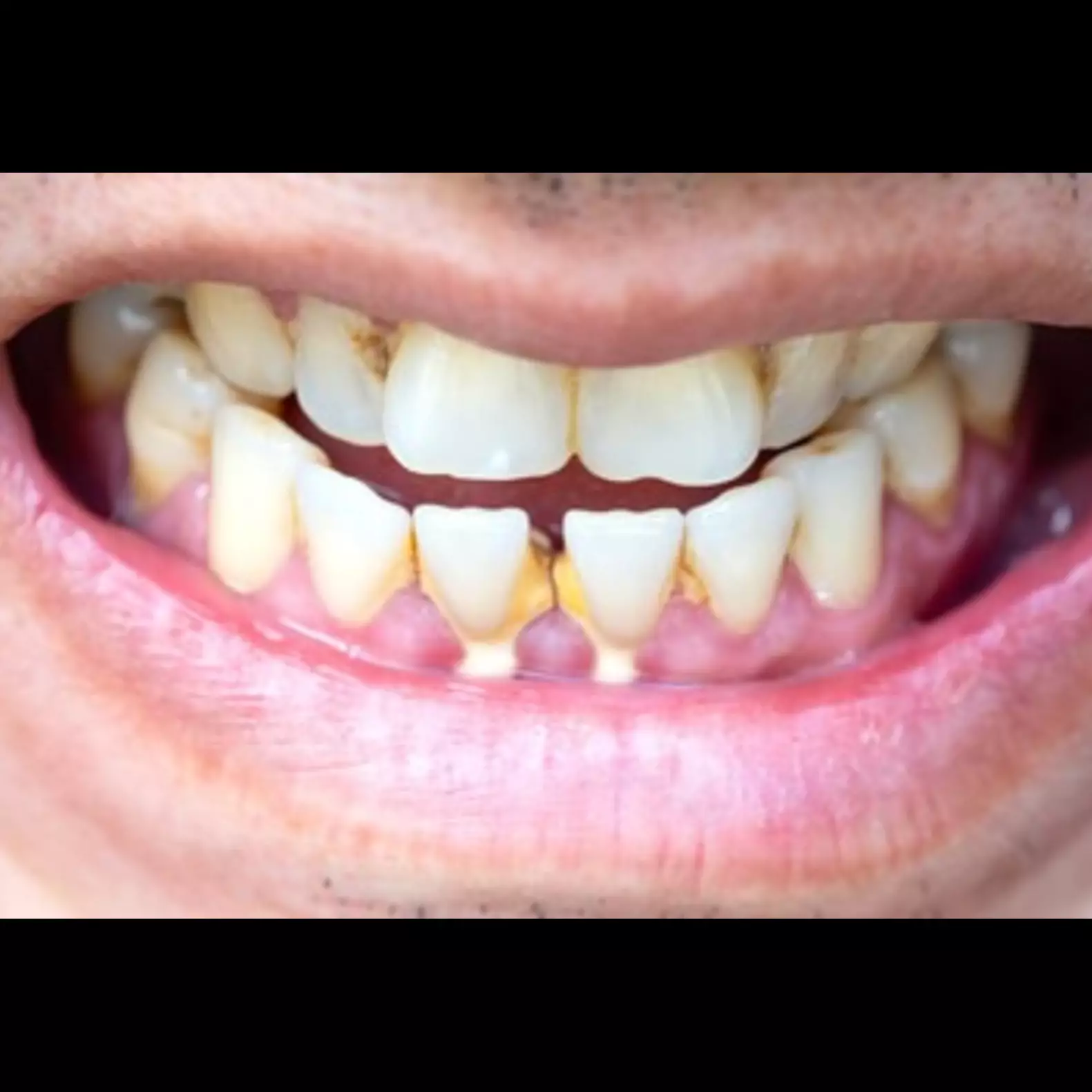 Tak perlu mengunyah jahe, ini trik mudah rontokkan karang gigi membandel pakai 1 rempah dapur