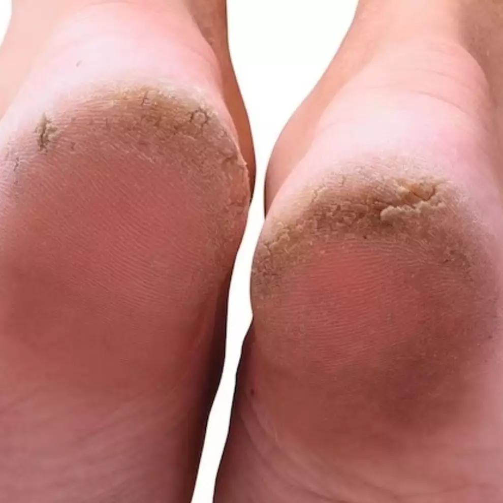 Bukan dioles madu, ini trik bikin tumit kering penuh retak jadi halus dan lembap pakai 2 bahan alami
