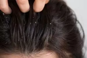 Bersih dari ketombe dan gatal, begini cara atasi kepala berminyak pakai 1 jenis bumbu dapur