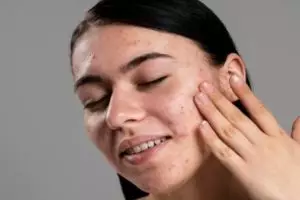 Tak perlu face paper, ini cara atasi wajah berminyak dan mudah berkomedo pakai 1 jenis rempah