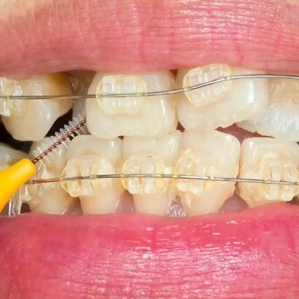 Hasil terlihat dalam 2 menit, ini cara optimalkan pasta gigi untuk pudarkan noda kuning pakai 1 daun