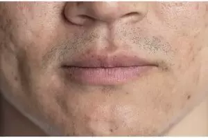 Tak ditambah susu, ini cara optimalkan sabun wajah agar pori-pori bebas kotoran pakai 1 jenis tanaman