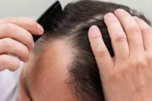 Tak perlu tambahan aloe vera gel, ini cara tumbuhkan rambut pitak area dahi pakai 3 jenis minyak