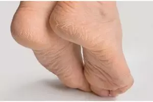 Tanpa gunakan krim wax, ini cara menghaluskan tumit kaki retak dan menghitam pakai 1 jenis buah