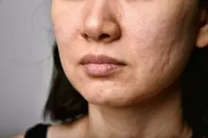 Tak lagi beli peel-off mask, ini cara bikin pori-pori rapat dan minim minyak pakai 1 jenis bunga