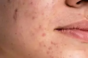 Wajah mulus tanpa laser, ini cara pudarkan flek dan noda hitam pakai masker dari 1 jenis buah