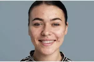 Tak gunakan krim pemutih, ini trik hilangkan flek hitam di wajah pakai krim dari 1 kulit buah