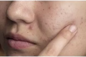 Tanpa ditambah bubuk kopi, ini trik bersihkan pori-pori wajah pakai masker dari 1 jenis tepung